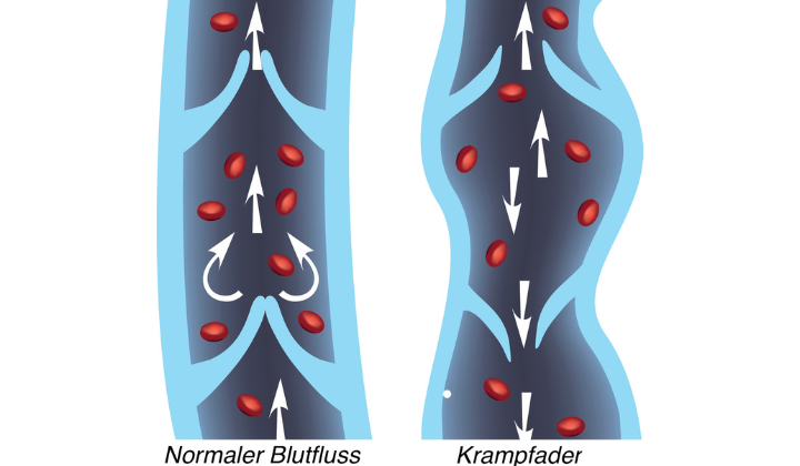 Blutfluss bei Krampfadern Blutfluss bei Krampfadern